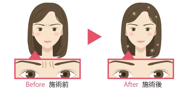 眉间皱纹治疗