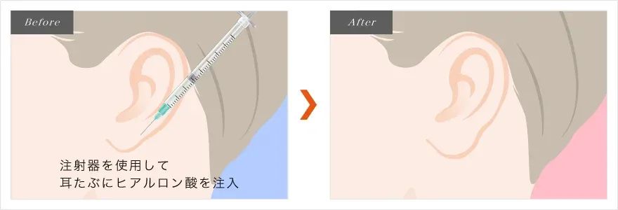 耳垂玻尿酸注射