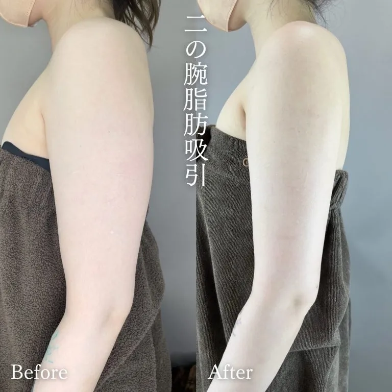 上臂・肩部吸脂