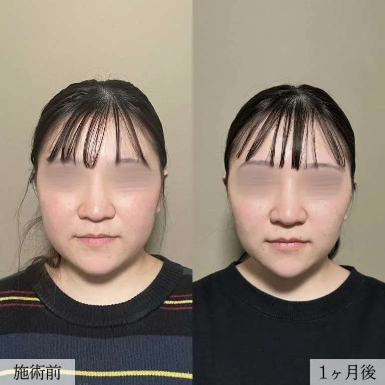 面部吸脂术案例照片