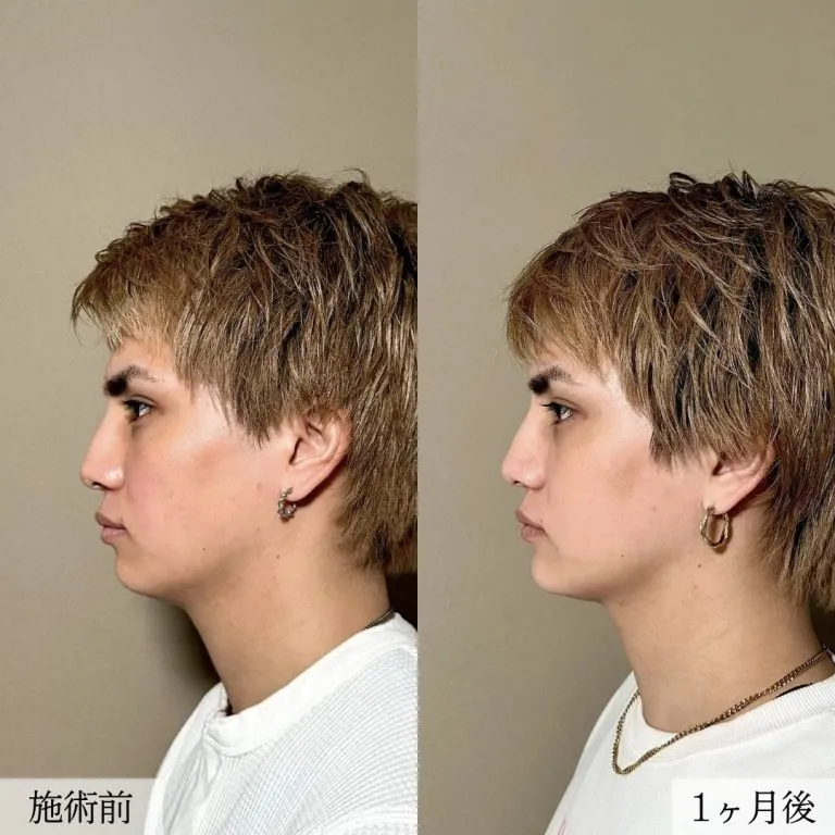 面部吸脂术案例照片