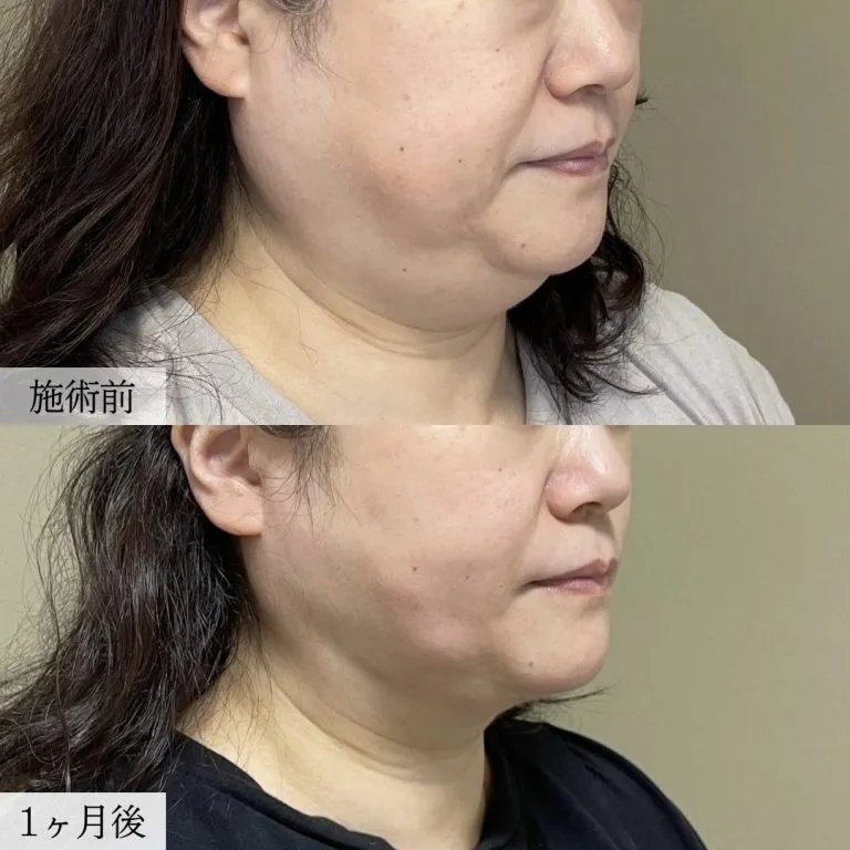 面部吸脂术案例照片