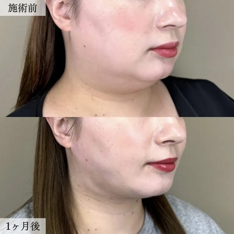 面部吸脂术案例照片