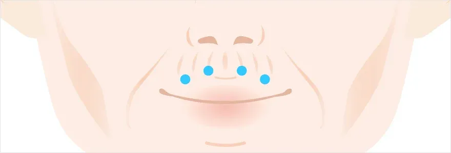 嘴周除皱肉毒素注射