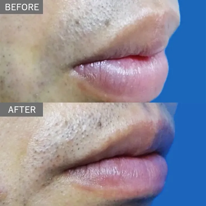 Smart Lip 唇形整形（厚唇缩薄术）