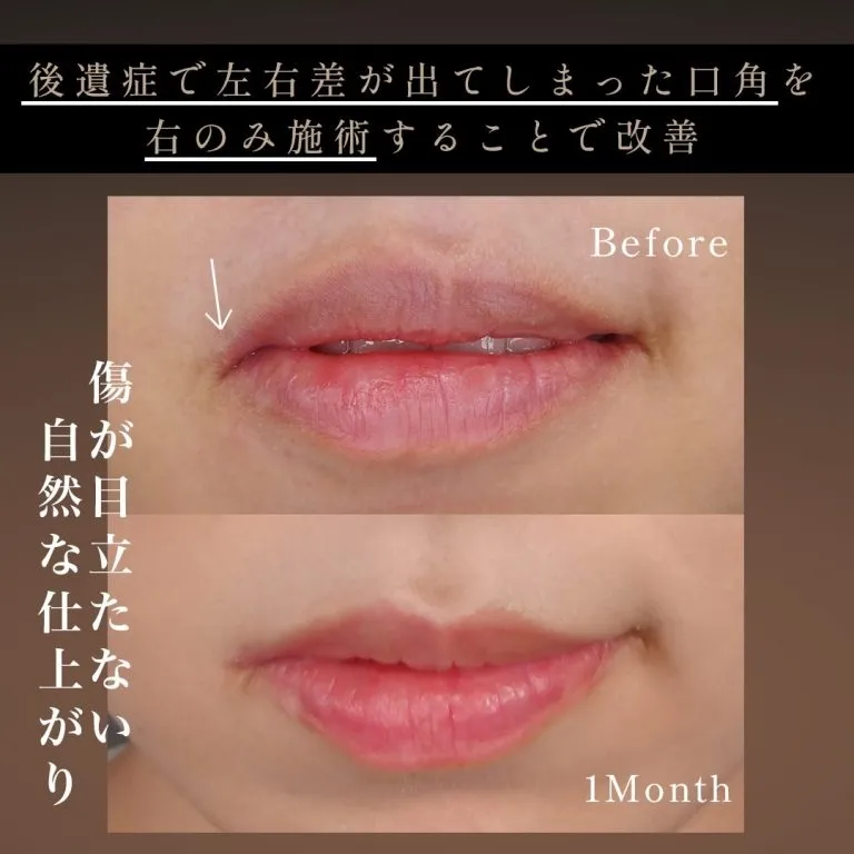 嘴角提升术（口角拉提）