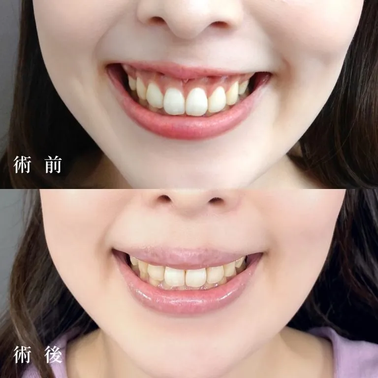 露龈笑治疗（切开法）