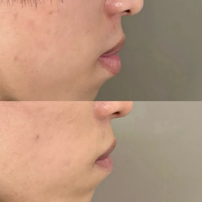 Smart Lip 唇形整形（厚唇缩薄术）