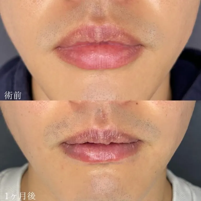Smart Lip 唇形整形（厚唇缩薄术）