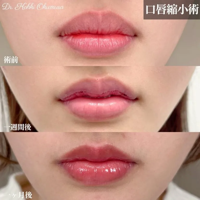 Smart Lip 唇形整形（厚唇缩薄术）