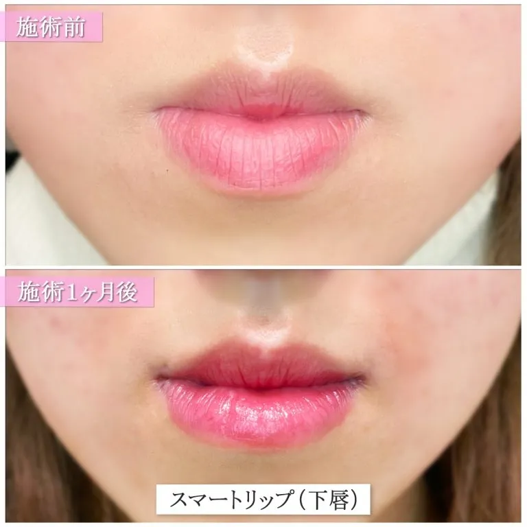 Smart Lip 唇形整形（厚唇缩薄术）