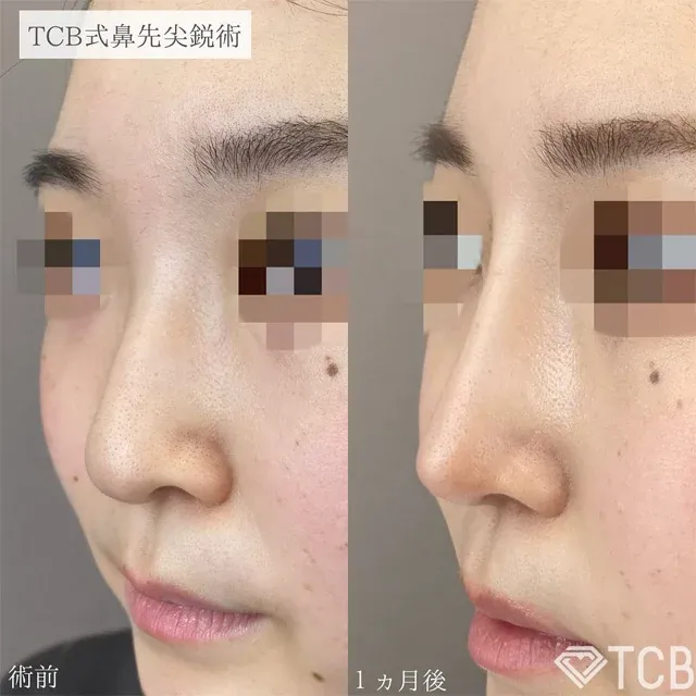 TCB尖鼻整形术（改善蒜头鼻）_after