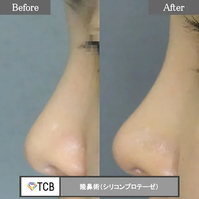 隆鼻术（硅胶假体）_before