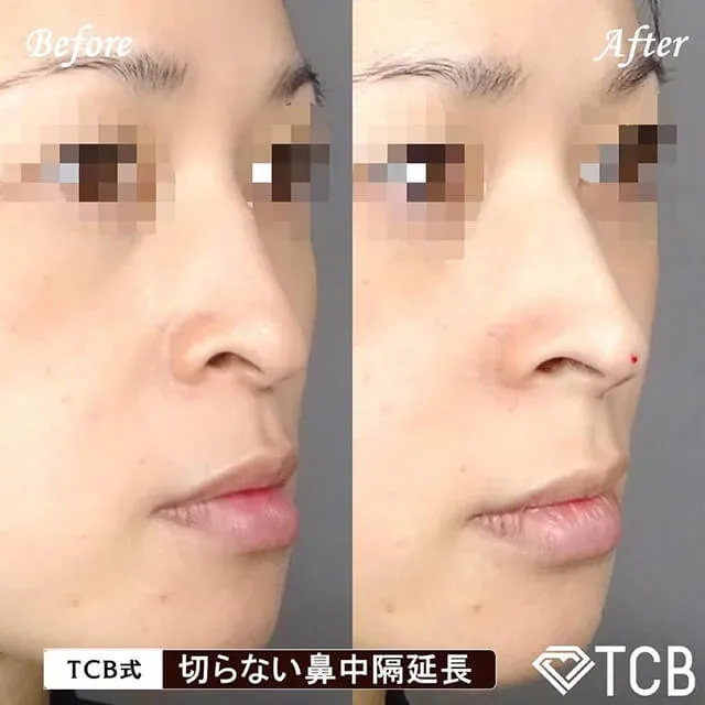 非手术鼻中隔延长_before