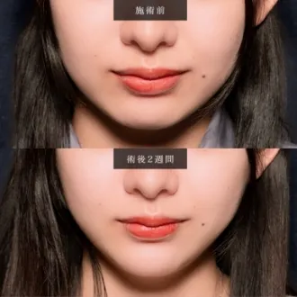 症例写真 小顔美肌再生（リフトアップ） 画像04