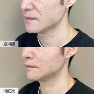 症例写真 小顔美肌再生（リフトアップ） 画像05