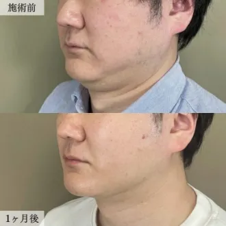 症例写真 顔の脂肪吸引 画像08