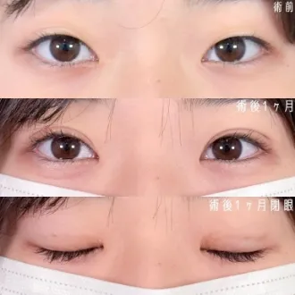 案例照片 双眼皮埋线法 图片01