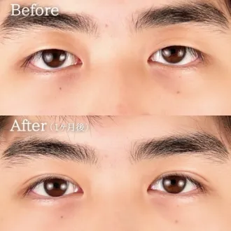 案例照片 双眼皮埋线法 图片02