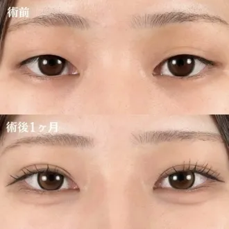 案例照片 双眼皮埋线法 图片03