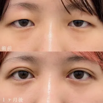 案例照片 双眼皮埋线法 图片07