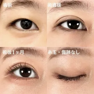 案例照片 双眼皮埋线法 图片08