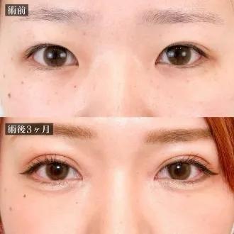 案例照片 双眼皮切开法 图片10