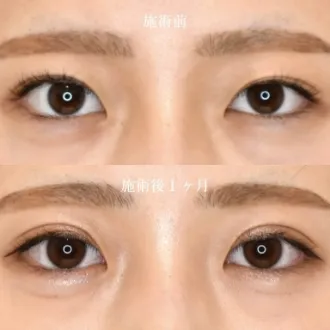 案例照片 双眼皮切开法 图片12