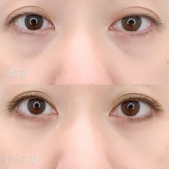 症例写真 クマ取り再生注射 画像10