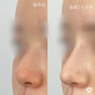 症例写真 TCBメッシュ 画像03