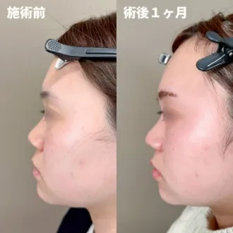 症例写真 鼻尖形成完全閉鎖法(切らない鼻尖形成) 画像06
