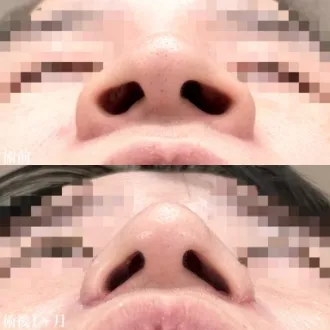 症例写真 切らない小鼻縮小（鼻翼縮小埋没法） 画像09