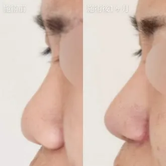 症例写真 鼻プロテーゼ（隆鼻術） 画像11